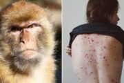 منظمة الصحة: ندرس تصنيف جدري القرود حالة طوارئ عالمية￼